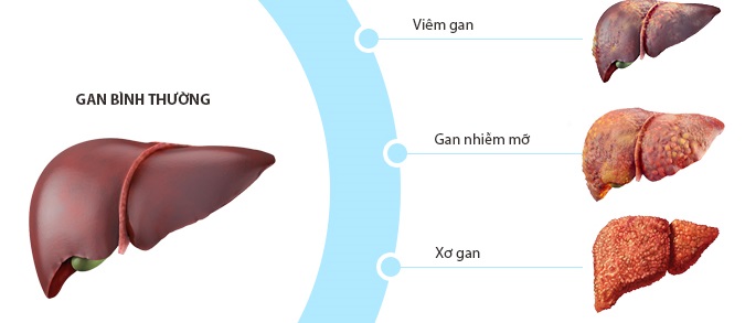 Các dấu hiệu của gan