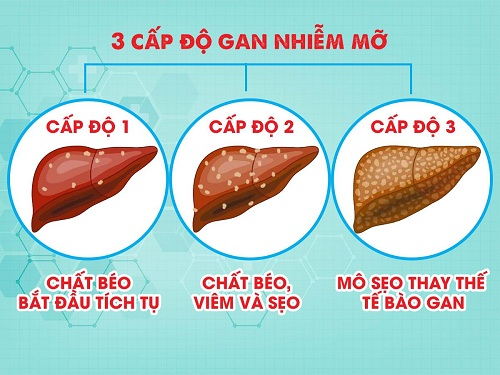3 cấp độ gan thoái hóa mỡ